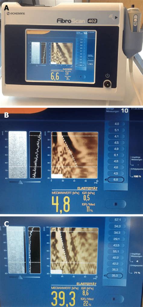 bad fibroscan results|Diagnosis of cirrhosis by transient elastography (FibroScan): a .